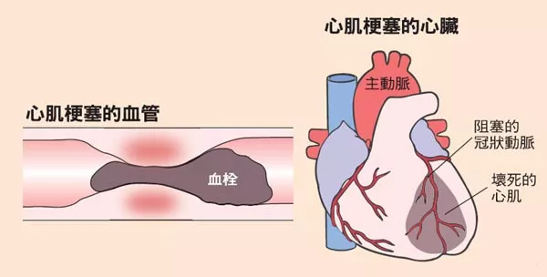 生死时速 我院胸痛中心同时完成两例急诊PCI